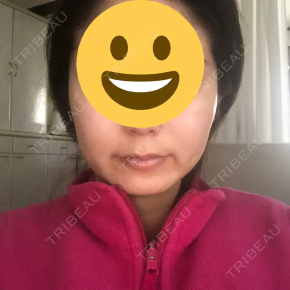 骨削り（エラ） / 骨削り（頬） / 脂肪吸引（顔） View美容整形外科 DAY 176 メイン用