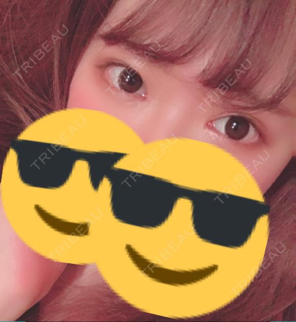 二重切開 / 目頭切開 聖心美容クリニック 札幌院 DAY 78 メイン用