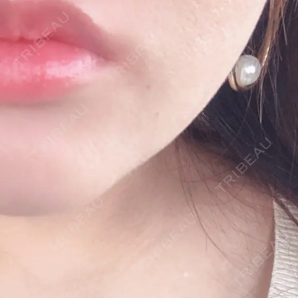 ボトックス（口角） 湘南美容クリニック 浜松院 DAY 0 メイン用