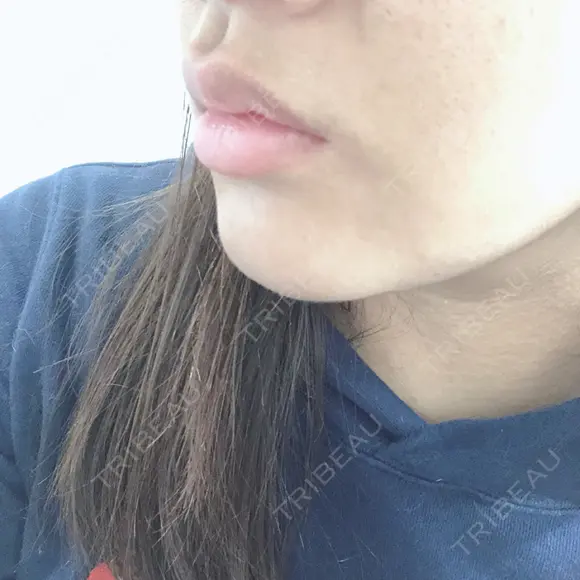 ボトックス（口角） 湘南美容クリニック 浜松院 DAY 2 メイン用