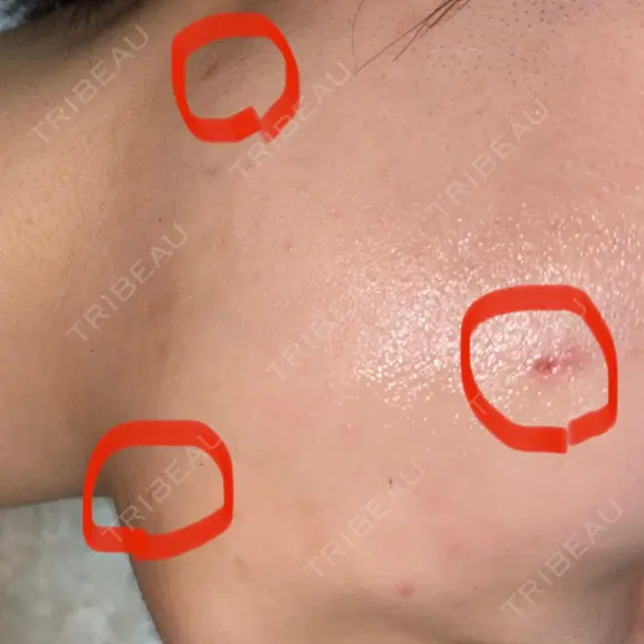 ほくろ・いぼ切除（肌） 赤坂メディカルMクリニック DAY 6 メイン用