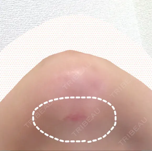 糸リフト / 脂肪吸引（顔） / その他（輪郭） / 切開リフト 清潭清楚整形外科 DAY 63 メイン用