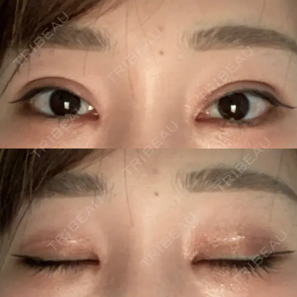 二重切開 / 目頭切開 / 鼻尖形成（切開） / 鼻中隔延長（切開） / 小鼻縮小（切開） / タレ目形成・グラマラスライン（切開） / 鼻尖縮小 / 鼻翼基部形成（貴族手術） グローバルビューティークリニック 大阪院 DAY 43 メイン用