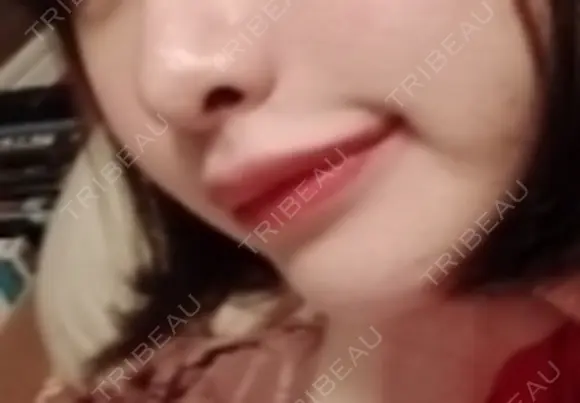 人中短縮 / 口角挙上 ドクターゴールドマンクリニック 東京高輪院 DAY 32 メイン用