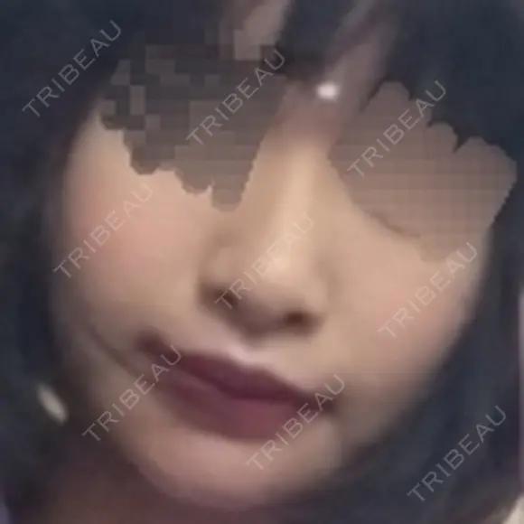 人中短縮 / 口角挙上 ドクターゴールドマンクリニック 東京高輪院 DAY 40 メイン用