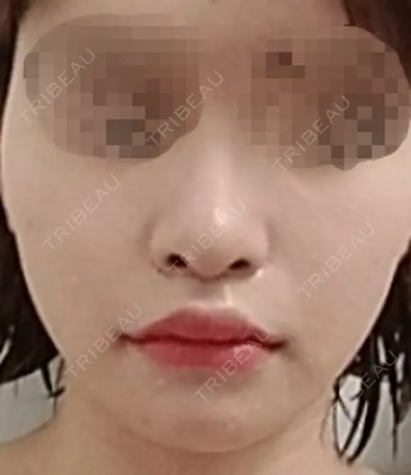 人中短縮 / 口角挙上 ドクターゴールドマンクリニック 東京高輪院 DAY 40 メイン用