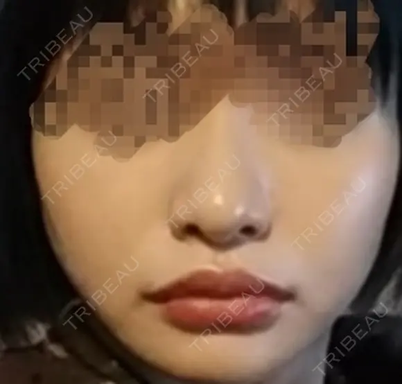 人中短縮 / 口角挙上 ドクターゴールドマンクリニック 東京高輪院 DAY 150 メイン用