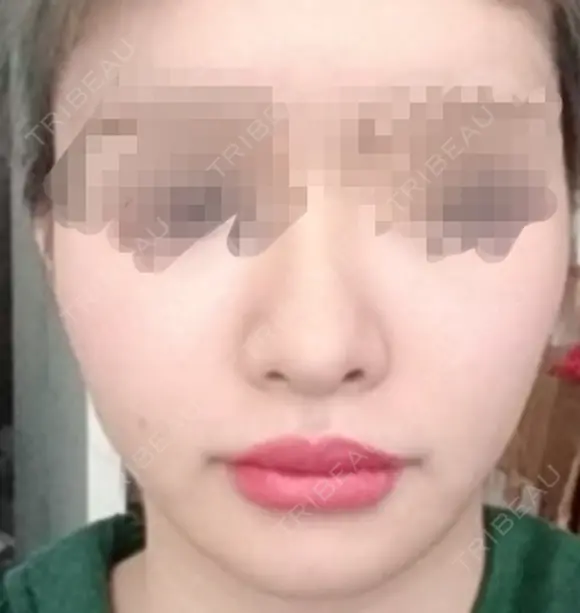 人中短縮 / 口角挙上 ドクターゴールドマンクリニック 東京高輪院 AFTER メイン用