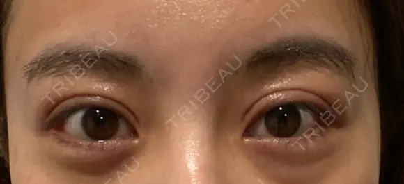 二重切開 / 眼瞼下垂（切開） / 目尻切開 / 上まぶたの脂肪取り / タレ目形成・グラマラスライン（切開） id（アイディ）美容外科 AFTER メイン用