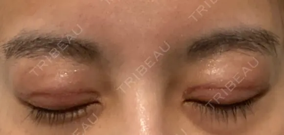 二重切開 / 眼瞼下垂（切開） / 目尻切開 / 上まぶたの脂肪取り / タレ目形成・グラマラスライン（切開） id（アイディ）美容外科 DAY 49 メイン用