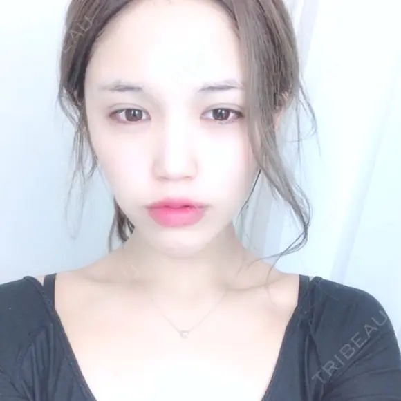 二重埋没 / 目頭切開 / 目尻切開 RG整形外科（旧リオン整形外科） DAY 98 メイン用