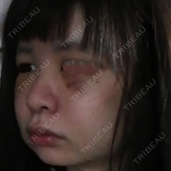 骨削り（頬） / 脂肪注入（肌） ボンディ美容整形外科（旧リオン整形外科） DAY 4 メイン用