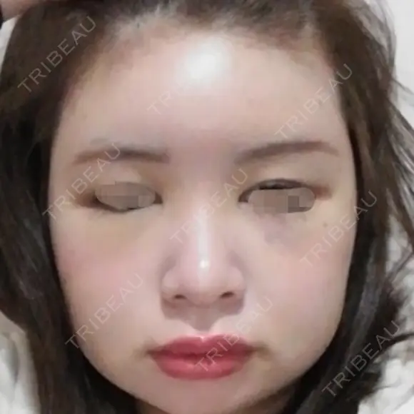 骨削り（頬） / 脂肪注入（肌） ボンディ美容整形外科（旧リオン整形外科） DAY 5 メイン用