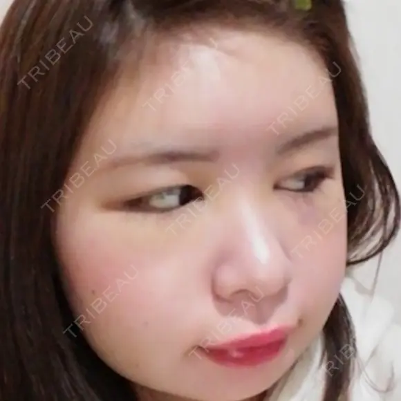 骨削り（頬） / 脂肪注入（肌） ボンディ美容整形外科（旧リオン整形外科） DAY 5 メイン用