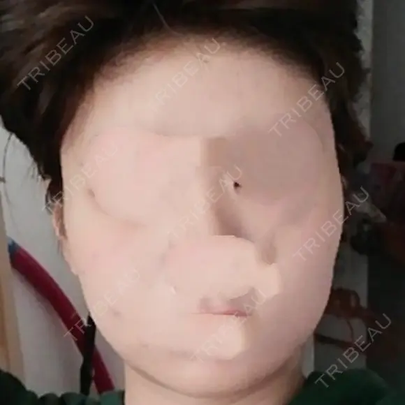 骨削り（頬） / 脂肪注入（肌） ボンディ美容整形外科（旧リオン整形外科） AFTER メイン用