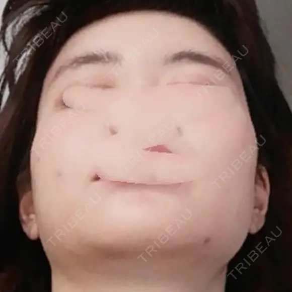 骨削り（頬） / 脂肪注入（肌） ボンディ美容整形外科（旧リオン整形外科） DAY 282 メイン用