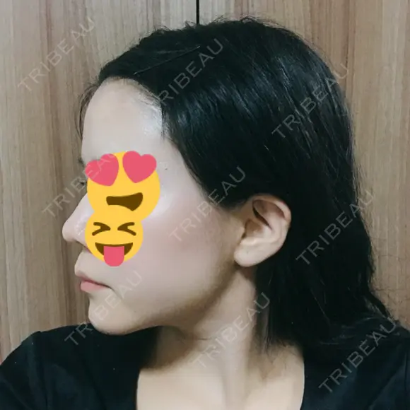 糸リフト / 脂肪吸引（顔） / その他（肌） ビューティーライン美容外科 DAY 41 メイン用