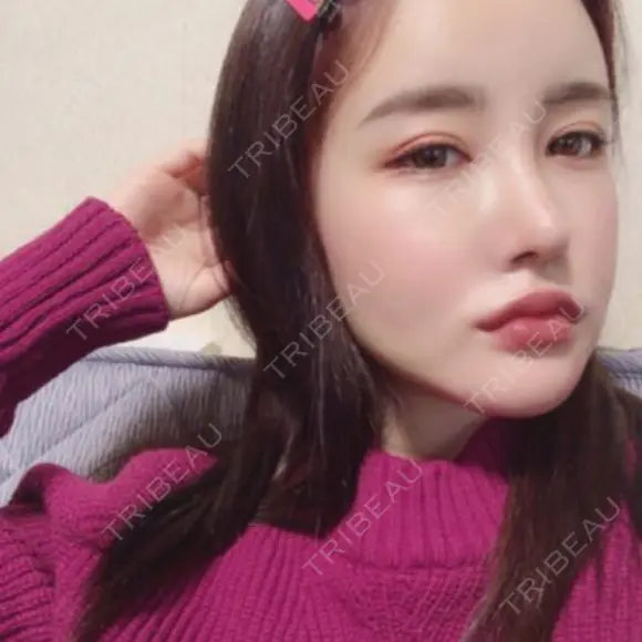 骨切り（あご） / 骨削り（頬） / 脂肪吸引（顔） / 鼻修正 / 脂肪注入（輪郭） DI（ディアイ）整形外科 DAY 21 メイン用