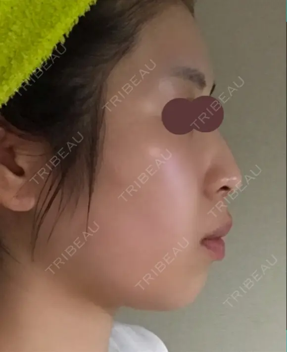 脂肪溶解注射（顔） 赤坂プレミアクリニック DAY 0 メイン用