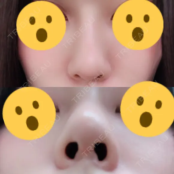 隆鼻術 / 鼻尖形成（切開） 湘南美容クリニック 名古屋院 AFTER メイン用