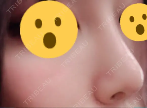 隆鼻術 / 鼻尖形成（切開） 湘南美容クリニック 名古屋院 DAY 78 メイン用