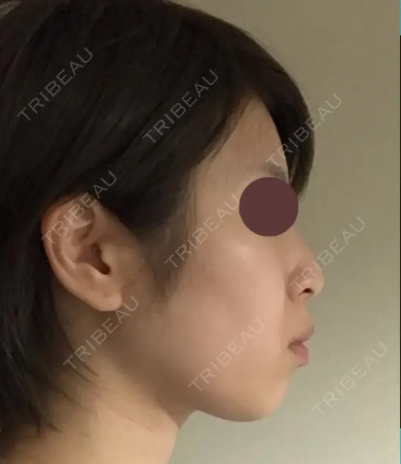 脂肪溶解注射（顔） 赤坂プレミアクリニック DAY 1 メイン用