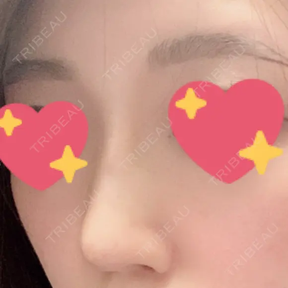 鼻修正 たにまちクリニック DAY 67 メイン用