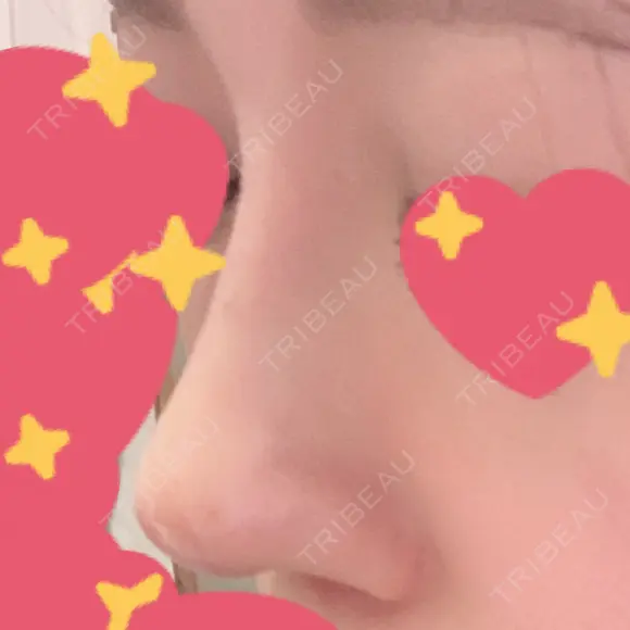 鼻修正 たにまちクリニック DAY 67 メイン用