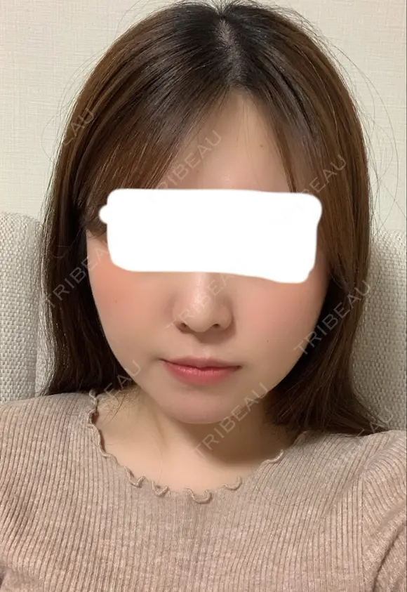 糸リフト / 骨切り（あご） / 骨削り（エラ） / 骨削り（頬） / 脂肪吸引（顔） RG整形外科（旧リオン整形外科） DAY 113 メイン用