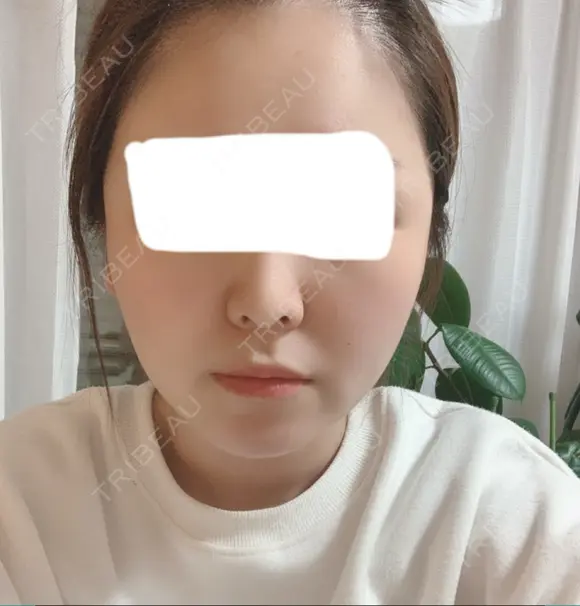 糸リフト / 骨切り（あご） / 骨削り（エラ） / 骨削り（頬） / 脂肪吸引（顔） RG整形外科（旧リオン整形外科） DAY 113 メイン用