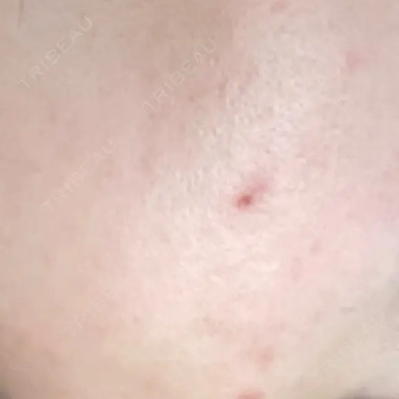 ほくろ・いぼ切除（肌） 赤坂メディカルMクリニック AFTER メイン用