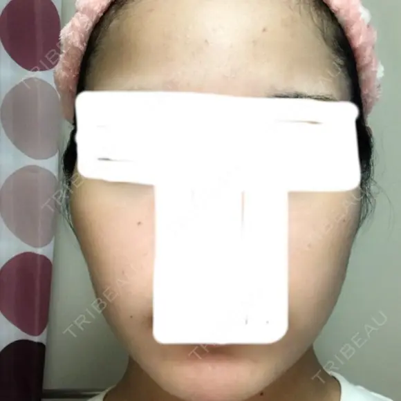 ボトックス（エラ・小顔） / 脂肪溶解注射（顔） / 脂肪溶解注射（二の腕） クリニックA.O. AFTER メイン用