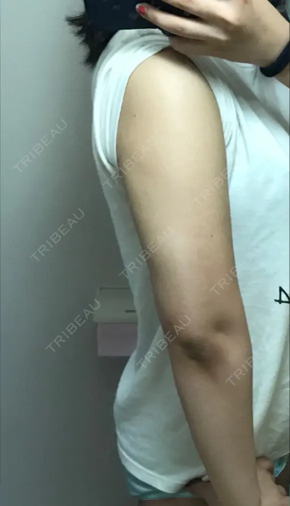 ボトックス（エラ・小顔） / 脂肪溶解注射（顔） / 脂肪溶解注射（二の腕） クリニックA.O. DAY 15 メイン用