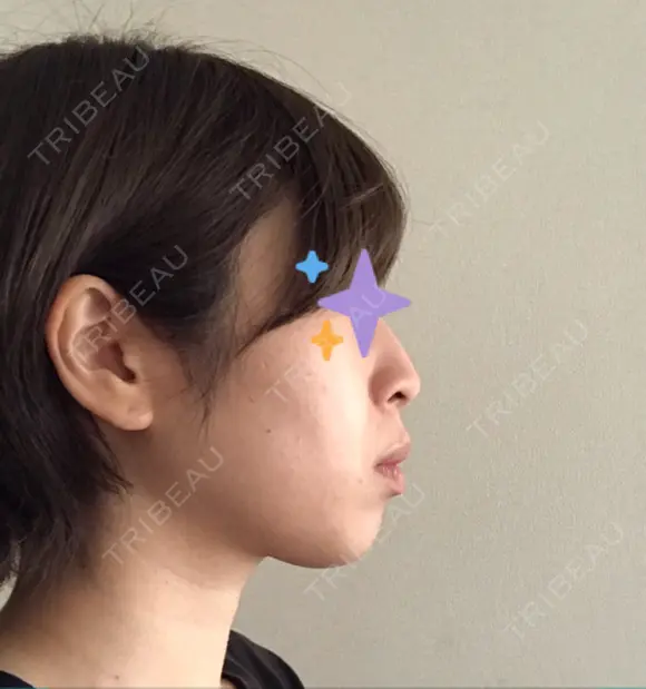 脂肪溶解注射（顔） 赤坂プレミアクリニック DAY 5 メイン用