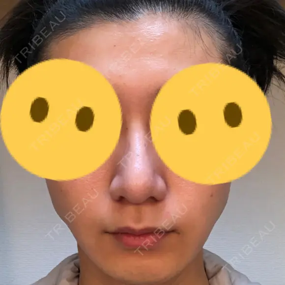 隆鼻術 / 鼻尖形成（切開） / 鼻中隔延長（切開） / 小鼻縮小（切開） / 軟骨移植 / 鼻孔縁挙上 / 鼻尖縮小 Zetith Beauty Clinic 銀座院 DAY 81 メイン用