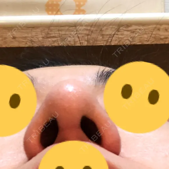 隆鼻術 / 鼻尖形成（切開） / 鼻中隔延長（切開） / 小鼻縮小（切開） / 軟骨移植 / 鼻孔縁挙上 / 鼻尖縮小 Zetith Beauty Clinic 銀座院 DAY 81 メイン用