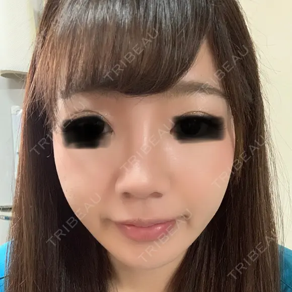 隆鼻術 / 鼻尖形成（切開） / 鼻中隔延長（切開） / 小鼻縮小（切開） / 鼻尖縮小 FROM B整形外科 (旧バウム整形外科) DAY 44 メイン用