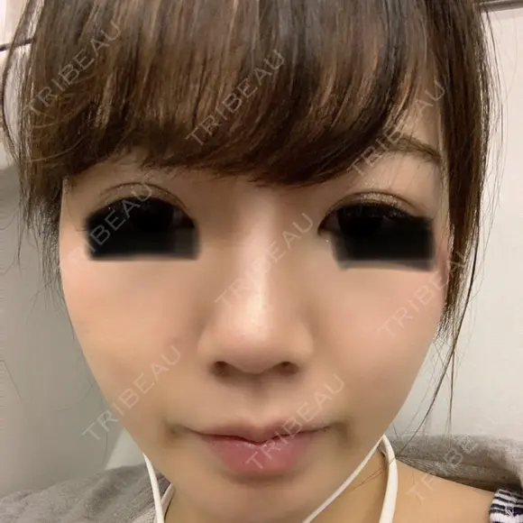 隆鼻術 / 鼻尖形成（切開） / 鼻中隔延長（切開） / 小鼻縮小（切開） / 鼻尖縮小 FROM B整形外科 (旧バウム整形外科) DAY 50 メイン用