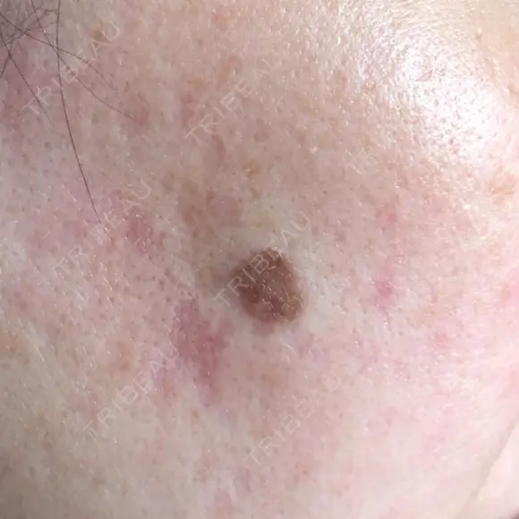 YAGレーザー 新宿美容外科クリニック 横浜院 DAY 1 メイン用