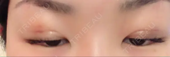 二重埋没 / 上まぶたの脂肪取り TCB東京中央美容外科 江坂院 DAY 4 メイン用