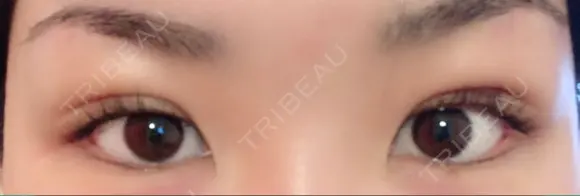 二重埋没 / 上まぶたの脂肪取り TCB東京中央美容外科 江坂院 DAY 4 メイン用