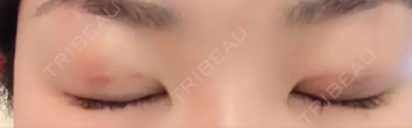 二重埋没 / 上まぶたの脂肪取り TCB東京中央美容外科 江坂院 DAY 4 メイン用