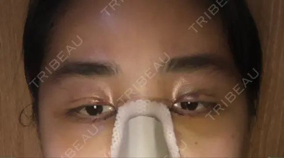 二重埋没 / 目頭切開 ラミチェ美容整形外科 DAY 3 メイン用