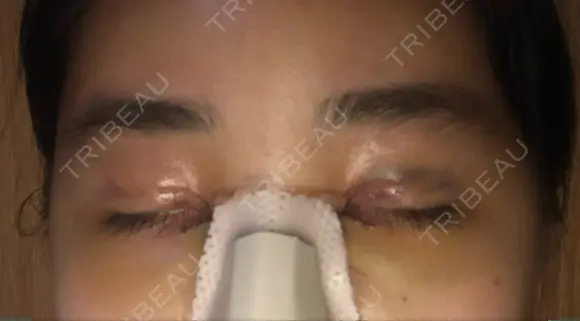 二重埋没 / 目頭切開 ラミチェ美容整形外科 DAY 3 メイン用