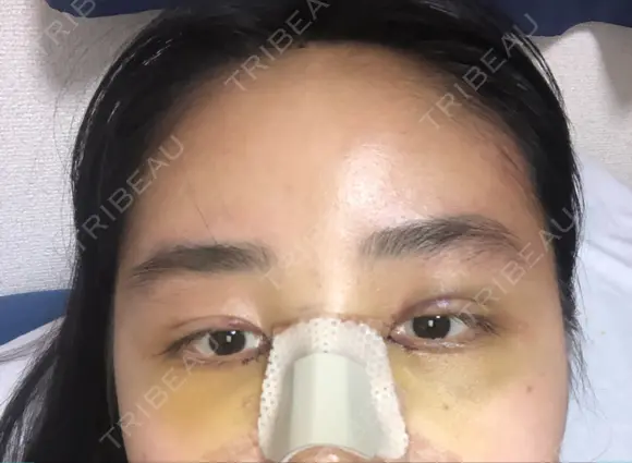 二重埋没 / 目頭切開 ラミチェ美容整形外科 DAY 7 メイン用