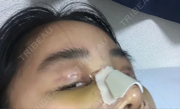 二重埋没 / 目頭切開 ラミチェ美容整形外科 DAY 7 メイン用
