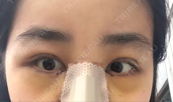 二重埋没 / 目頭切開 ラミチェ美容整形外科 DAY 9 メイン用