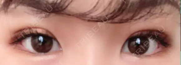 二重埋没 / 上まぶたの脂肪取り TCB東京中央美容外科 江坂院 DAY 5 メイン用