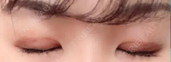 二重埋没 / 上まぶたの脂肪取り TCB東京中央美容外科 江坂院 DAY 5 メイン用