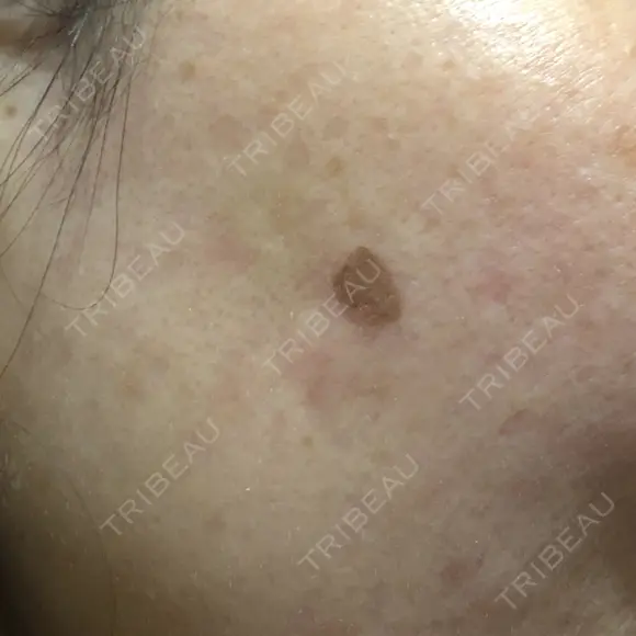 YAGレーザー 新宿美容外科クリニック 横浜院 DAY 1 メイン用